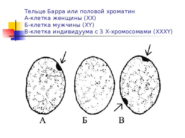 Тельце Барра или половой хроматин  А-клетка женщины (ХХ)  Б-клетка мужчины (Х Y )  В-клетка индивидуума с 3 Х-хромосомами (XXXY)