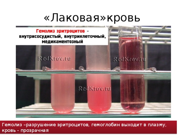 «Лаковая»кровь Гемолиз –разрушение эритроцитов, гемоглобин выходит в плазму, кровь - прозрачная