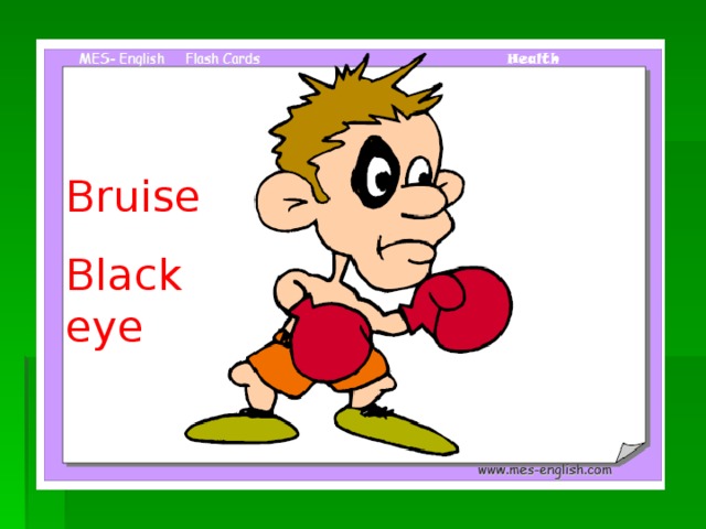 Bruise Black eye Black eye