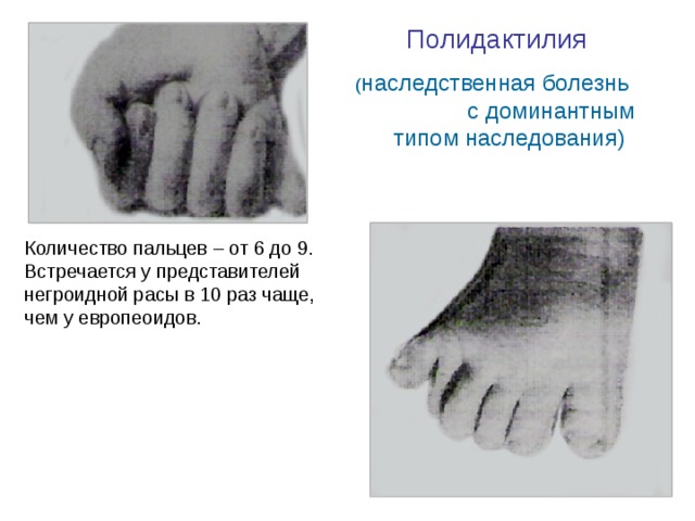 Полидактилия  ( наследственная болезнь с доминантным типом наследования) Количество пальцев – от 6 до 9. Встречается у представителей негроидной расы в 10 раз чаще, чем у европеоидов.