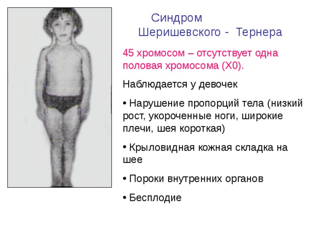 Синдром Шеришевского - Тернера 45 хромосом – отсутствует одна половая хромосома (Х0). Наблюдается у девочек