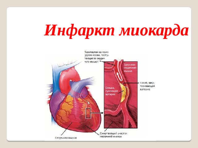 Инфаркт миокарда