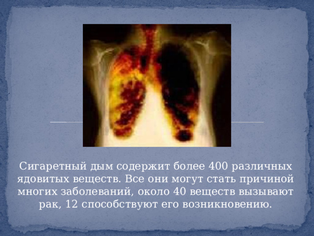 Сигаретный дым содержит более 400 различных ядовитых веществ. Все они могут стать причиной многих заболеваний, около 40 веществ вызывают рак, 12 способствуют его возникновению.
